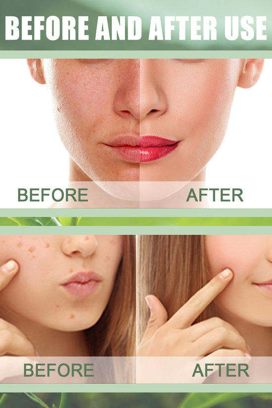 Green Tea Mask Stick for Acne and Blackhead Removal